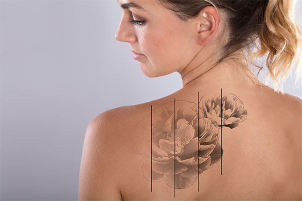 Erase Your Ink Regrets: Discover the Benefits of Laser Tattoo Removal in Dubai