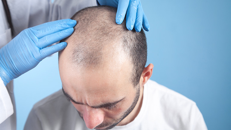 best hair transplant clinic in Delhi