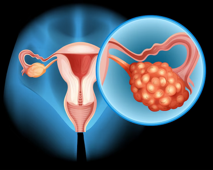 Types of Ovarian Cysts and Their Surgical Treatment Options