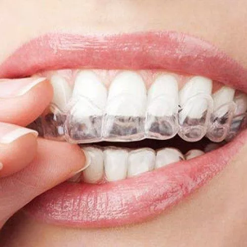 Invisalign Treatment in Aberdeen