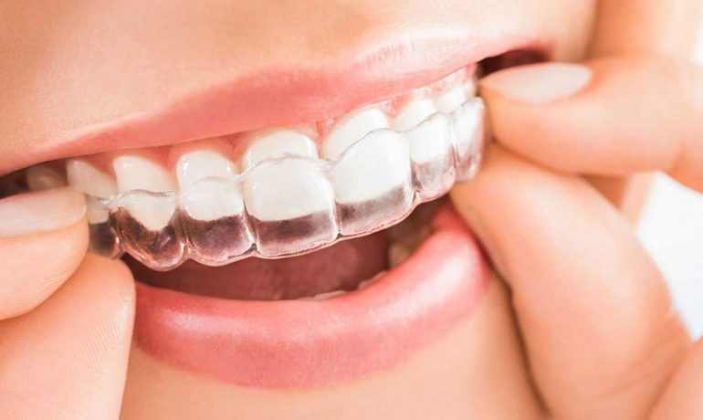 Invisalign in St. Helens