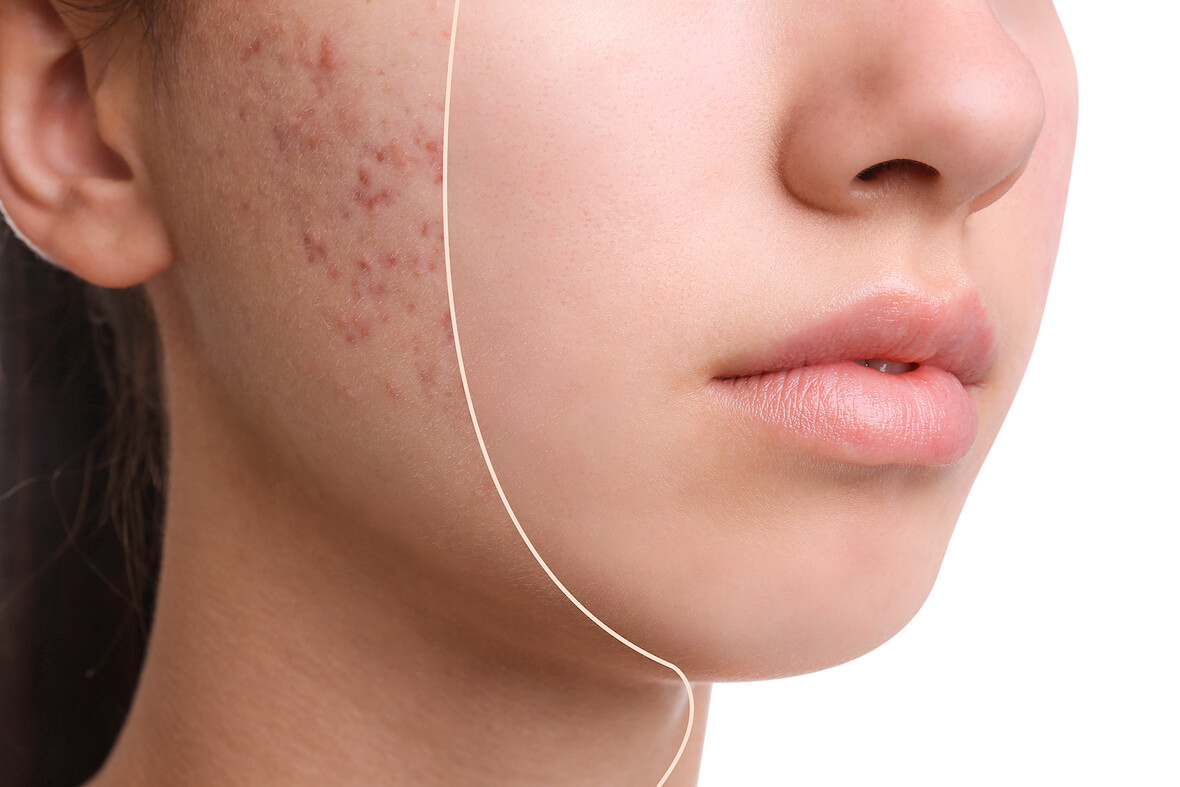 dermatologist Singapore acne