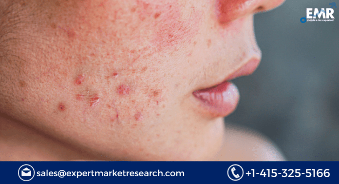 Hidradenitis Suppurativa Treatment Market