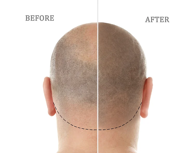 Scalp Micropigmentation Explained in Dubai