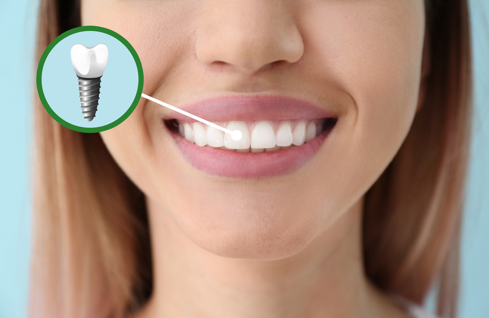 Best Dental implants in Aberdeen