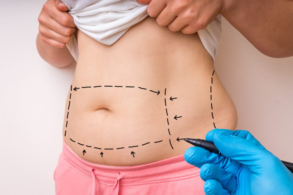 liposuction in Ludhiana