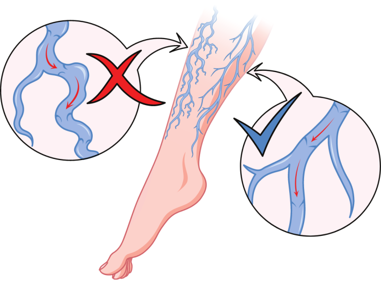 Peripheral Arterial Disease