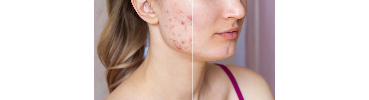 Acne Removal near me