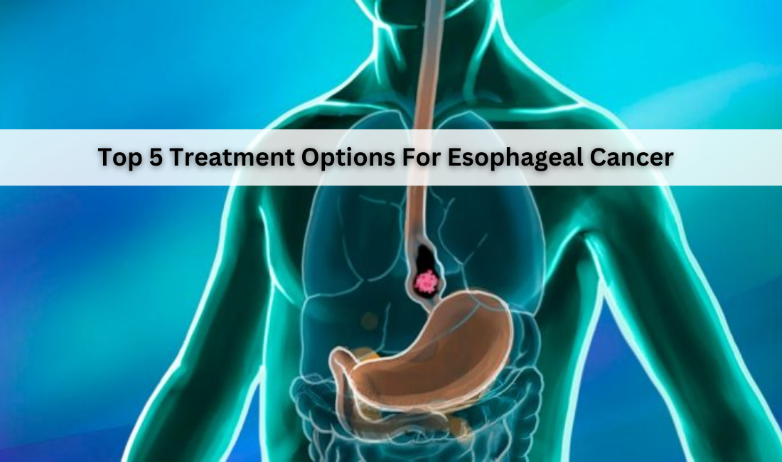 Top 5 Treatment Options For Esophageal Cancer