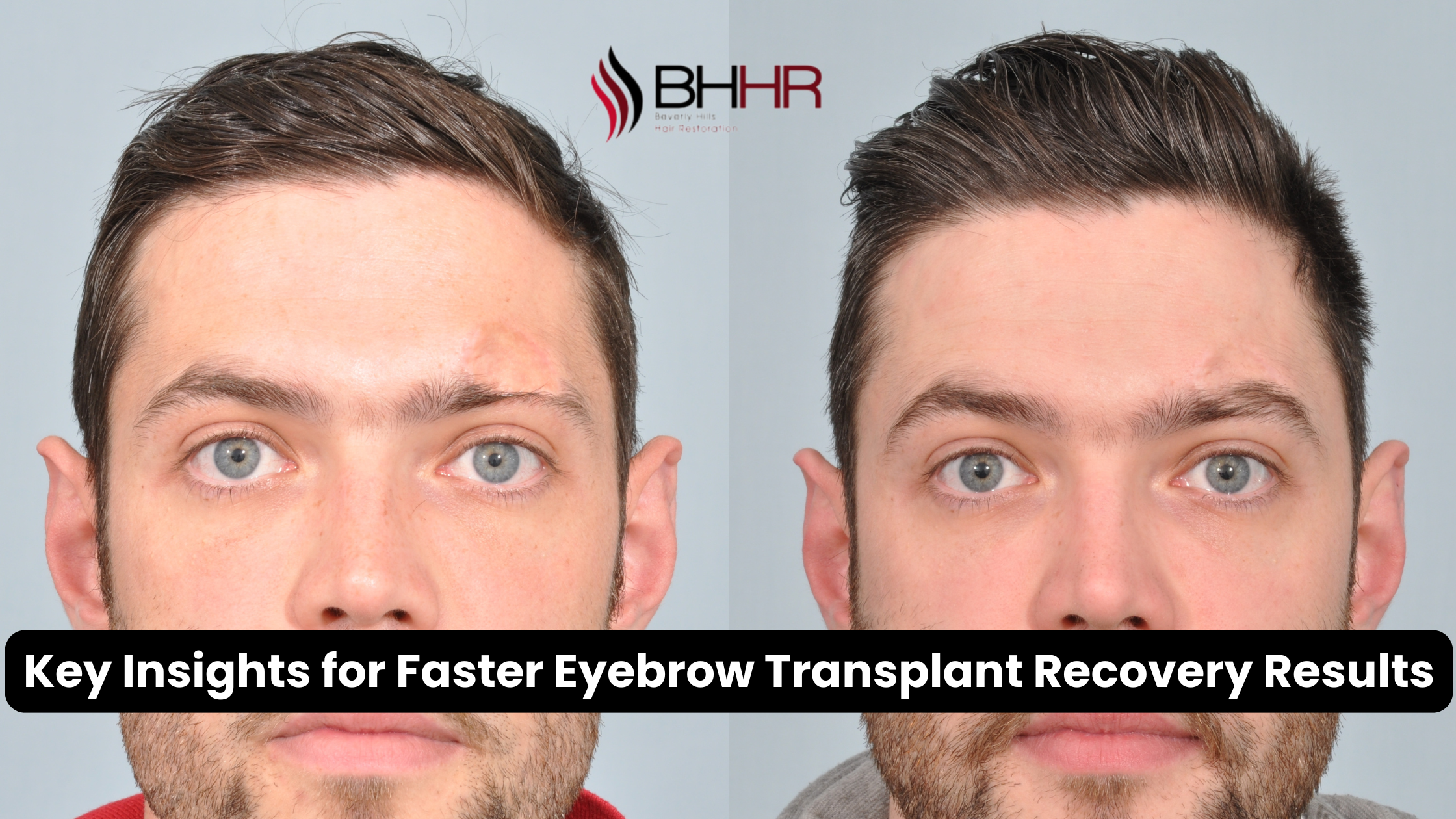 eyebrow transplant recovery