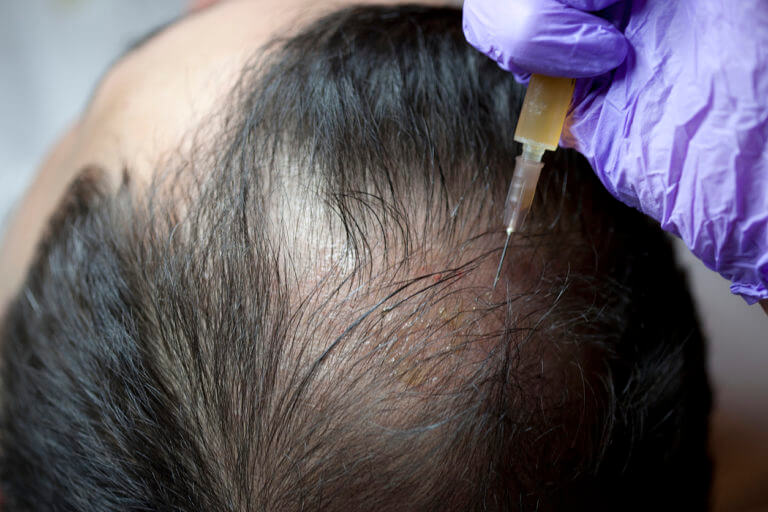 Transform Your Hair with the Best PRP and Hair Restoration Treatments in Stafford