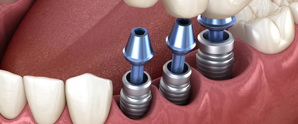 dental implants Cardiff