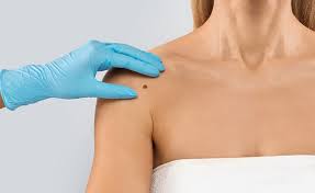 Rejuvence Clinic: The Trusted Name in London Skin Tag Removal